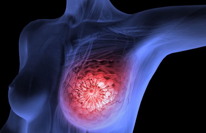 breast_cancer
